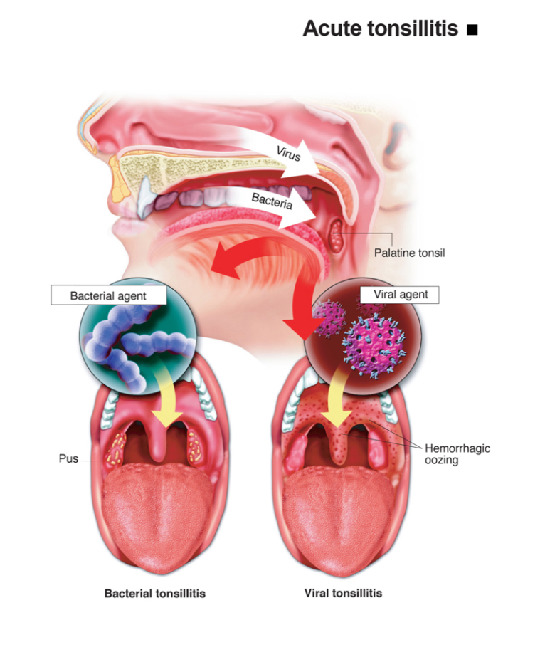 Infografis tonsilitis akut